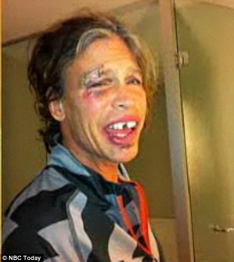 ŠOK Neprepoznavni Steven Tyler poln modric in brez zob
