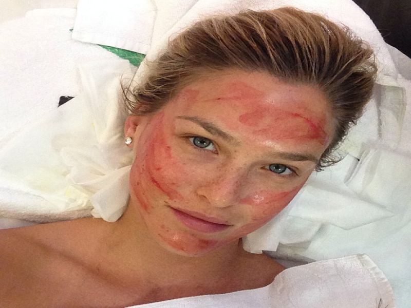 Foto! Bar Refaeli: Za lepoto se poslužuje krvavega tretmaja!