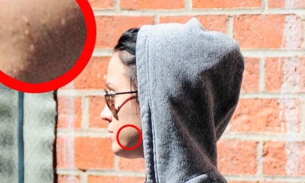 FOTO Katy Perry tik pred poroko mozoljasta kot najstnica
