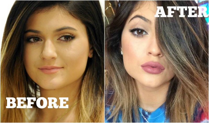 VIDEO! Tako lahko dosežete povečanje ustnic v stilu Kylie Jenner!