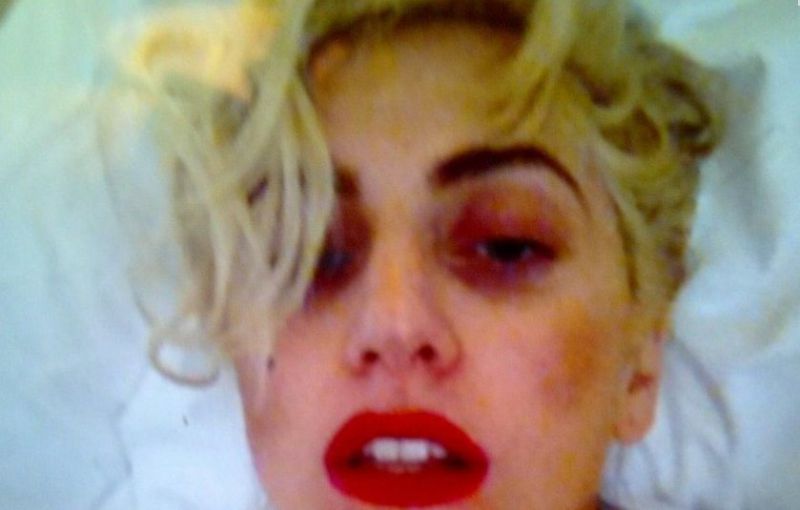AUČ! Lady GaGa se hvali z veliko modrico na glavi
