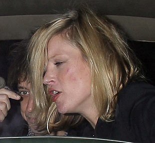 Vinjena in opraskana Kate Moss