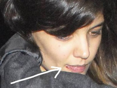 Herpes na ustnici Katie Holmes