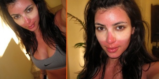 Opečena Kim Kardashian