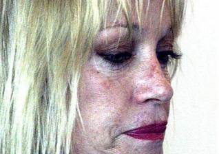 ŠOKANTNO Melanie Griffith šokirala z modričasto kožo
