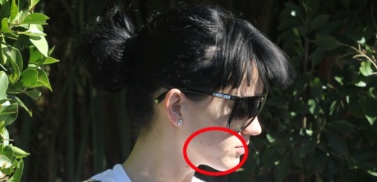 Katy ima težave z aknami