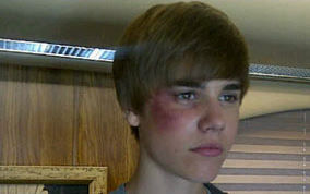 FOTO: Pretepen Justin Bieber: Z modrico na obrazu!