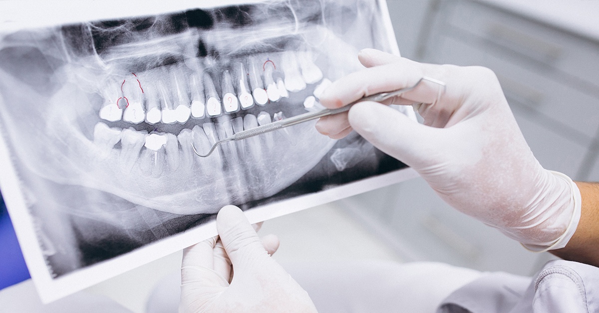 Endodontsko zdravljenje na napotnico brez čakalne dobe.