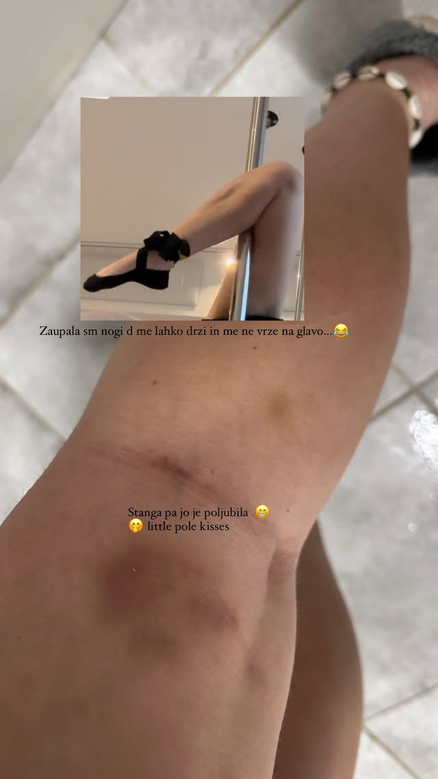 Maša Levačič in njene modrice. Vir: Instagram